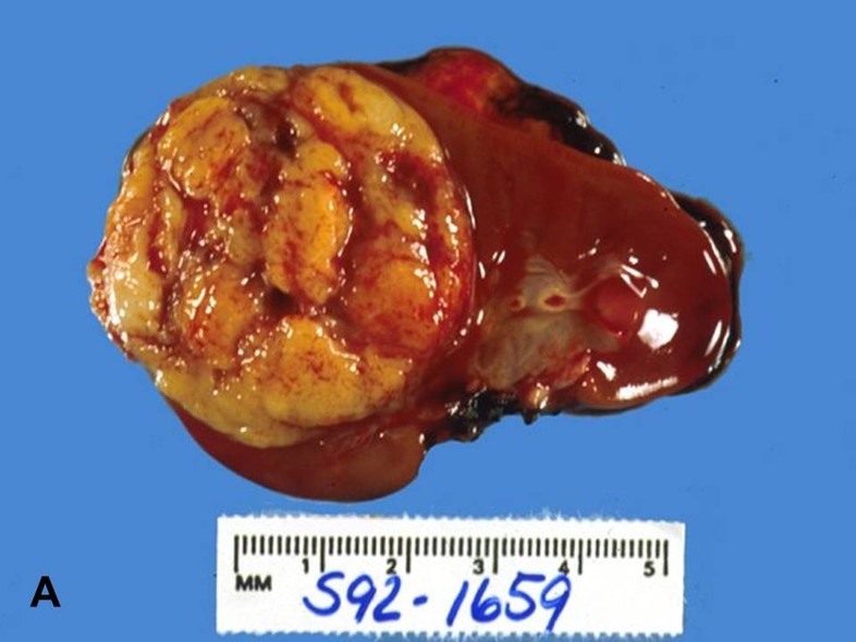 nephroblastoma-figureA_Big-(1).jpg