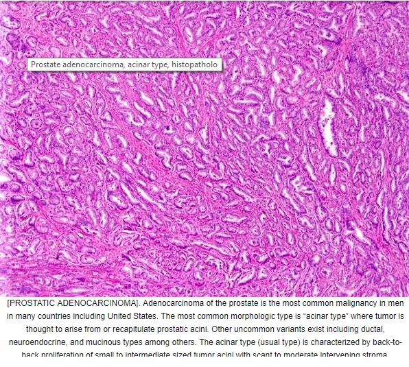  Prostatic adenocarcinoma