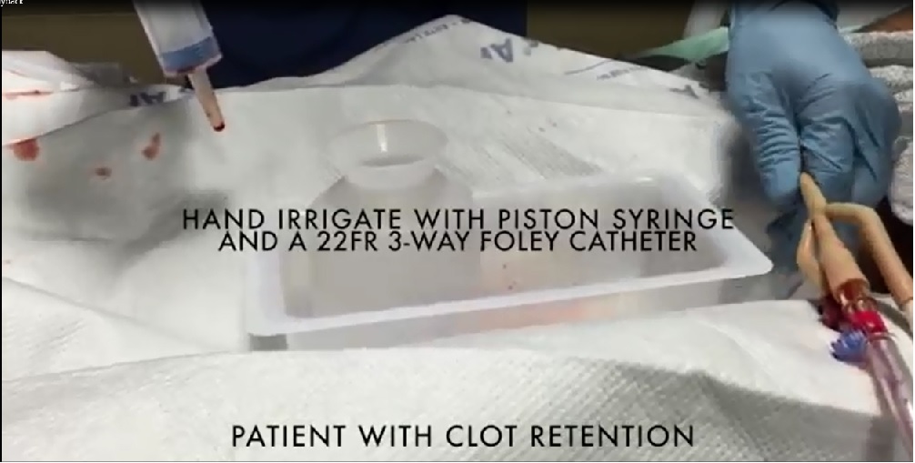 3-way Foley catheter hand-irrigation with a Piston Syringe for Hematuria