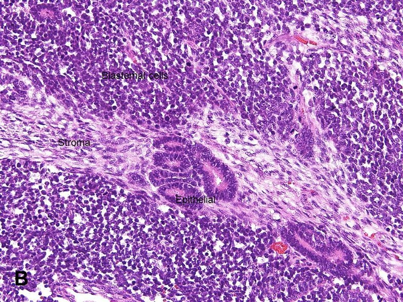 nephroblastoma-figureB_Big.jpg