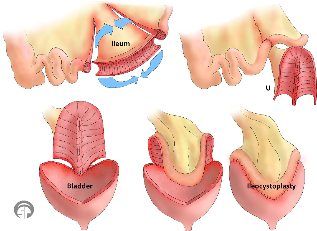 bladder augmentation