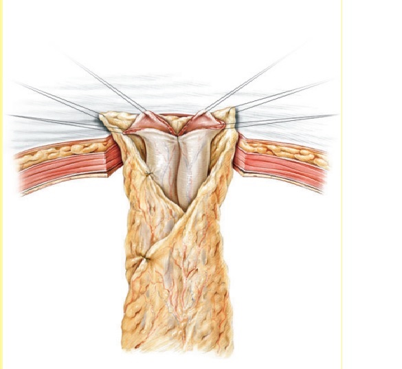 CUTANEOUS URETEROSTOMY FOR ADULTS AS AN ALTERNATIVE TO THE ILEAL CONDUIT