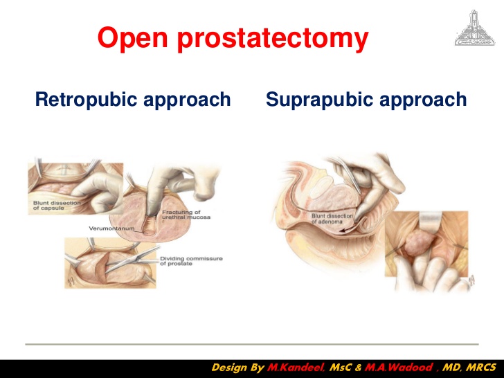 suprapubic prostatectomy-2