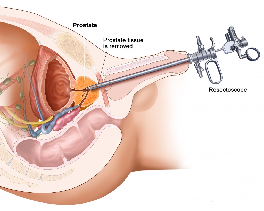 How to pass resectoscope to bladder in High bladder neck