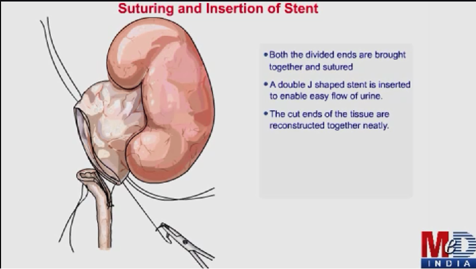 Pyeloplasty(ANIMATION)