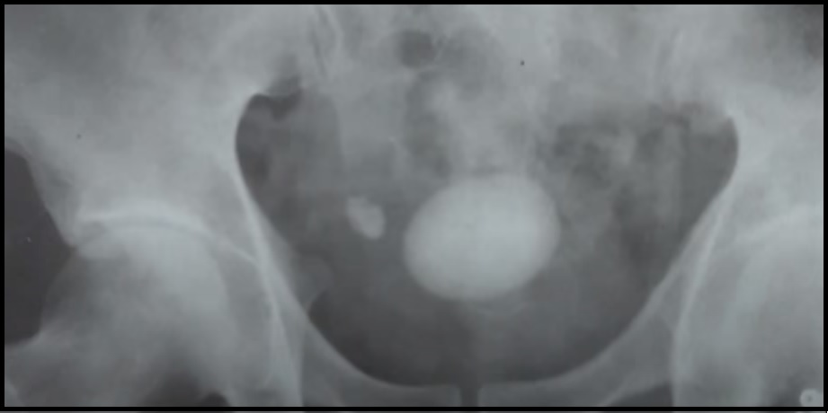 ureterolithotomy+vesicolithotomy