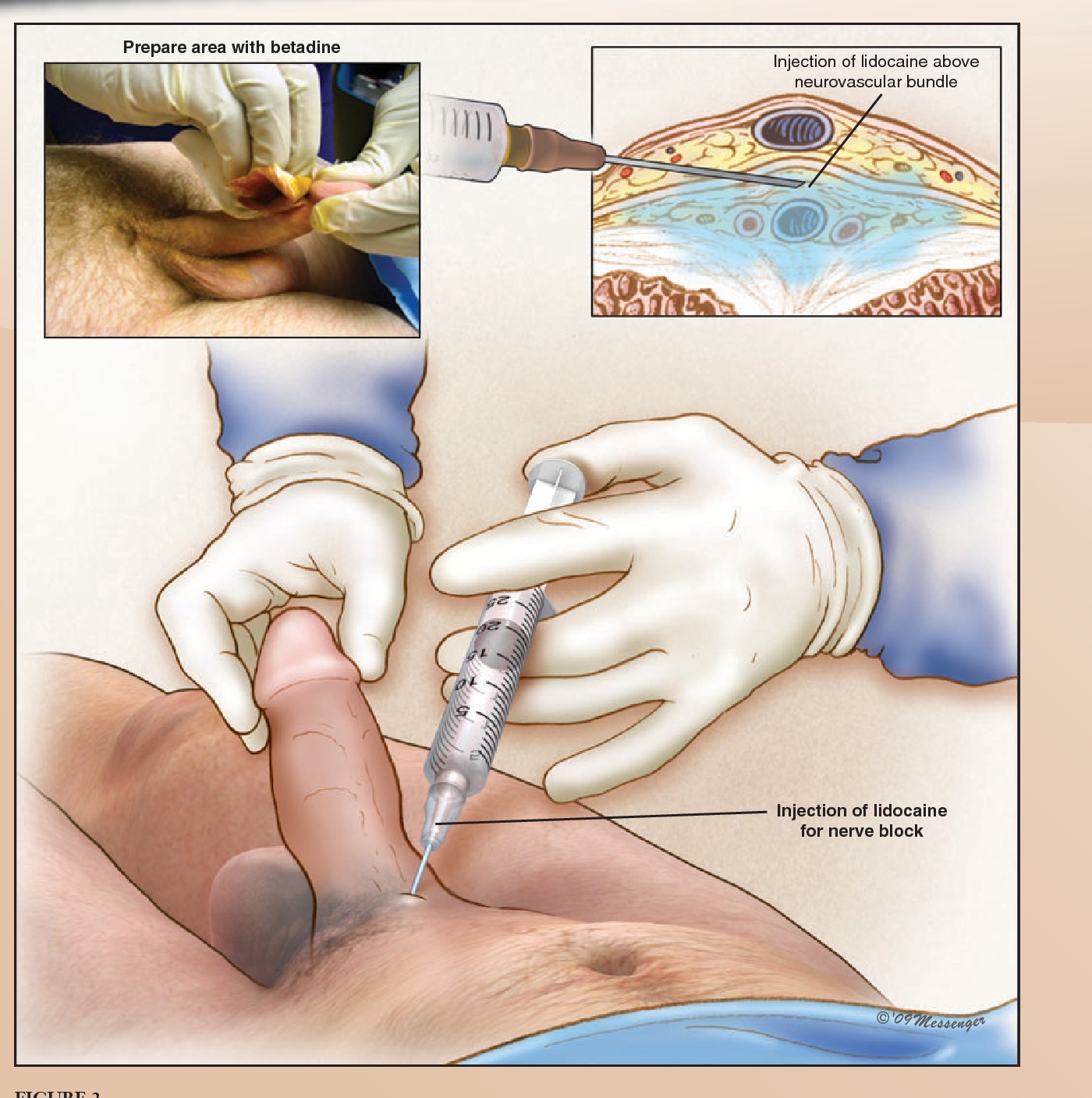 Peyronie's disease Intralesional steroid under penile block