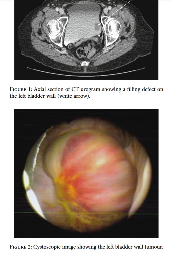 Metastatic Melanoma to the Urinary Bladde