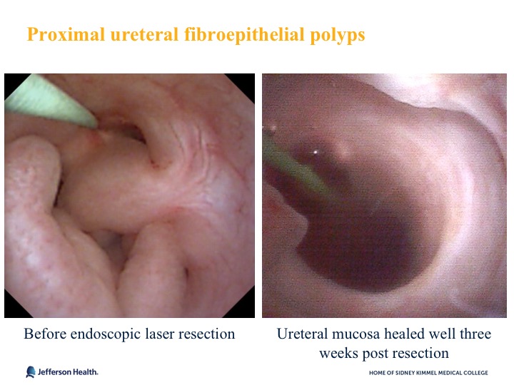Robot Assisted Fibroepithelial Polyp Resection