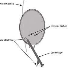 obturator jerk full thickness Bladder perforation