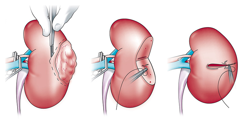 surgical aproach to RCC-LECTURE