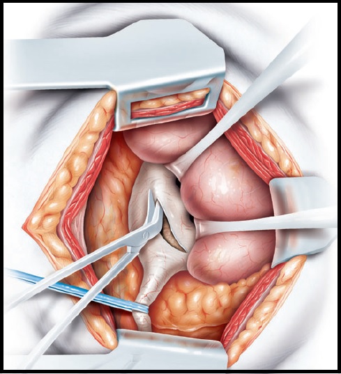 Open Pyelolithotomy sep by step