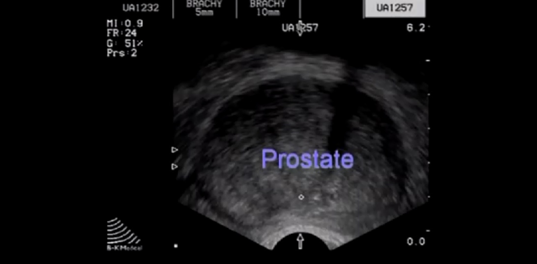 Transrectal Ultrasound Prostate Biopsy - Periprostatic Nerve Block