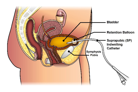 Open Insertion of Suprapubic Catheter