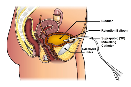 Academic Learning Of Urology Procedures - Open Insertion of Suprapubic  Catheter