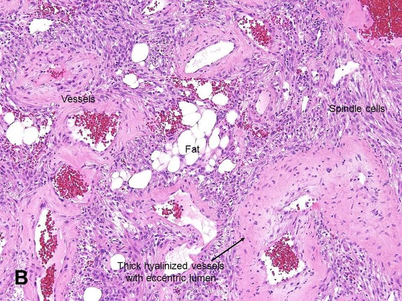 pathology station/Renal Angiomyolipoma