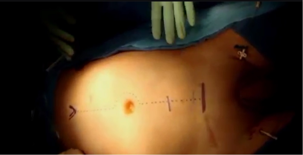 retroperitoneal lymph node dissection