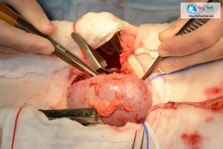 kidney transplantation 