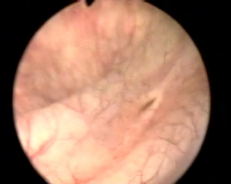 Recovering a percutaneous tract with methylene blue and air