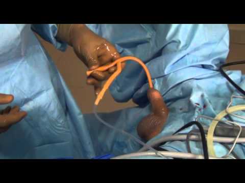  Placing the triple lumen catheter with guide