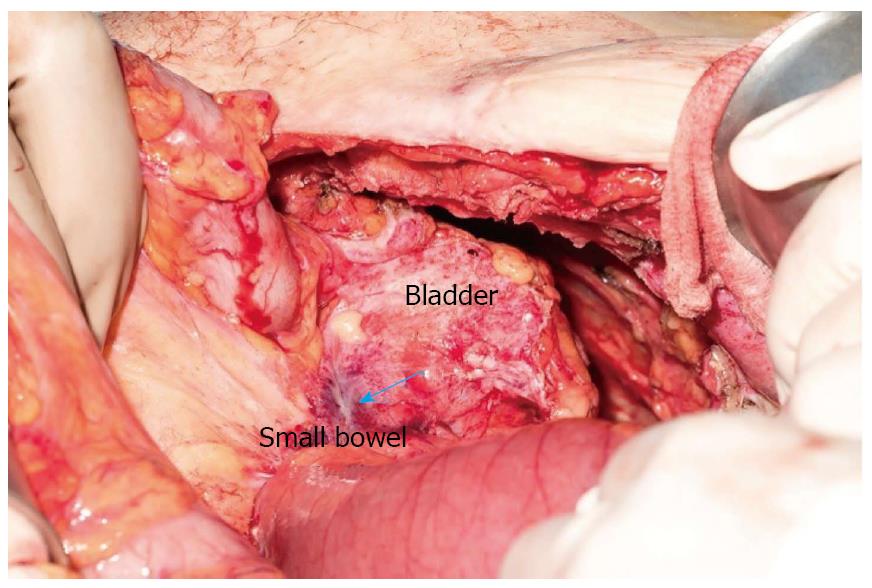 open radical cystectomy