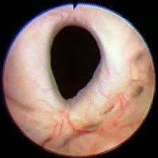 How To Deal With Bladder Neck Contracture
