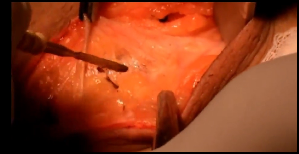 Varicocelectomy with Cauterization