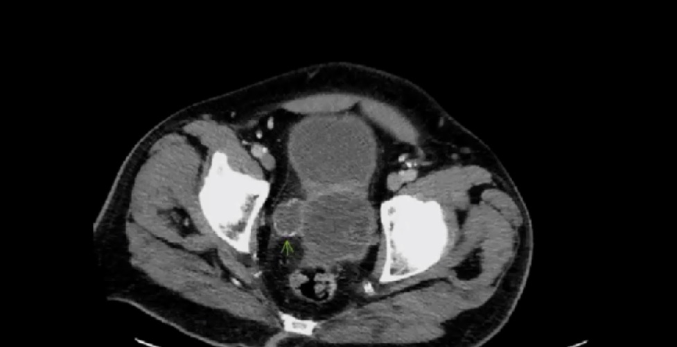 Transurethral De-Roofong of the Prostatic  abscess