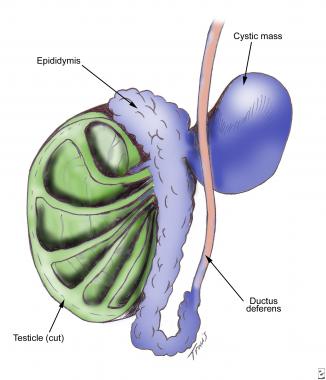 spermatocelectomy