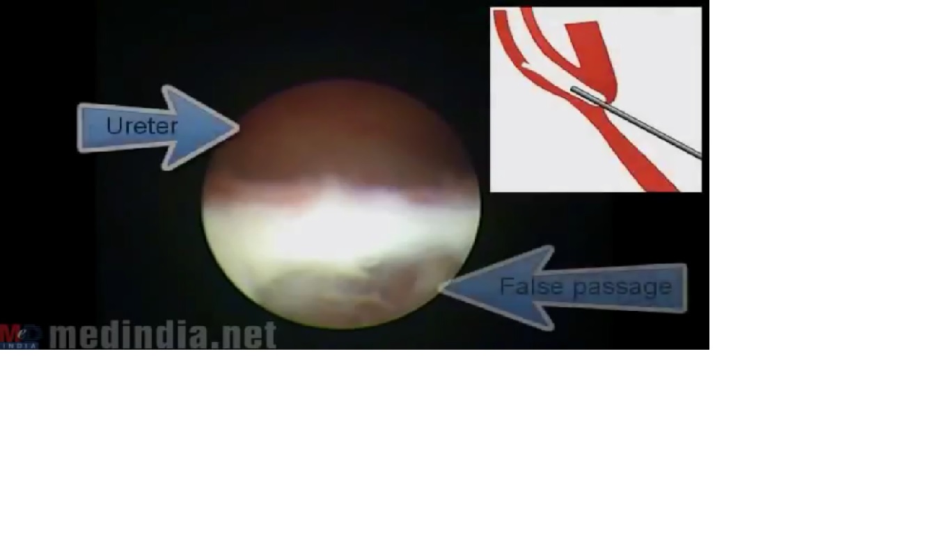 Ureteric false passage