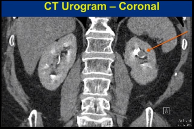 Bipolar Resection of Large Upper Tract Urothelial Carcinoma (UTUC) via Percutaneous Renal Access