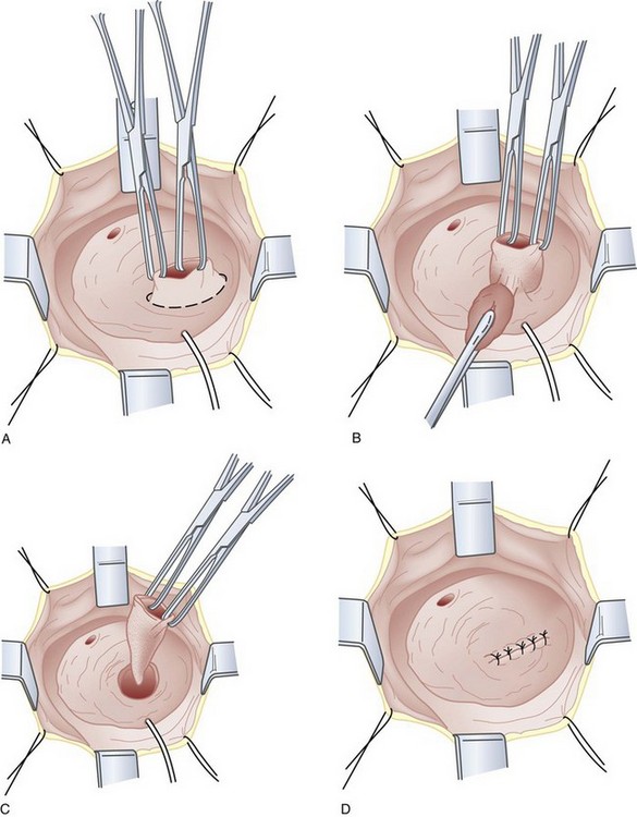 Bladder diverticulectomy