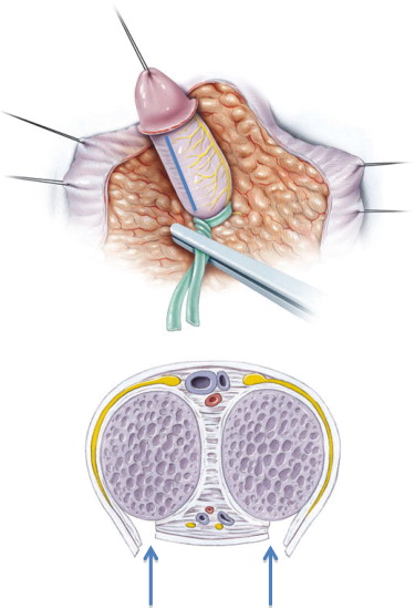 surgery of congenital Adernal Hyperplasia