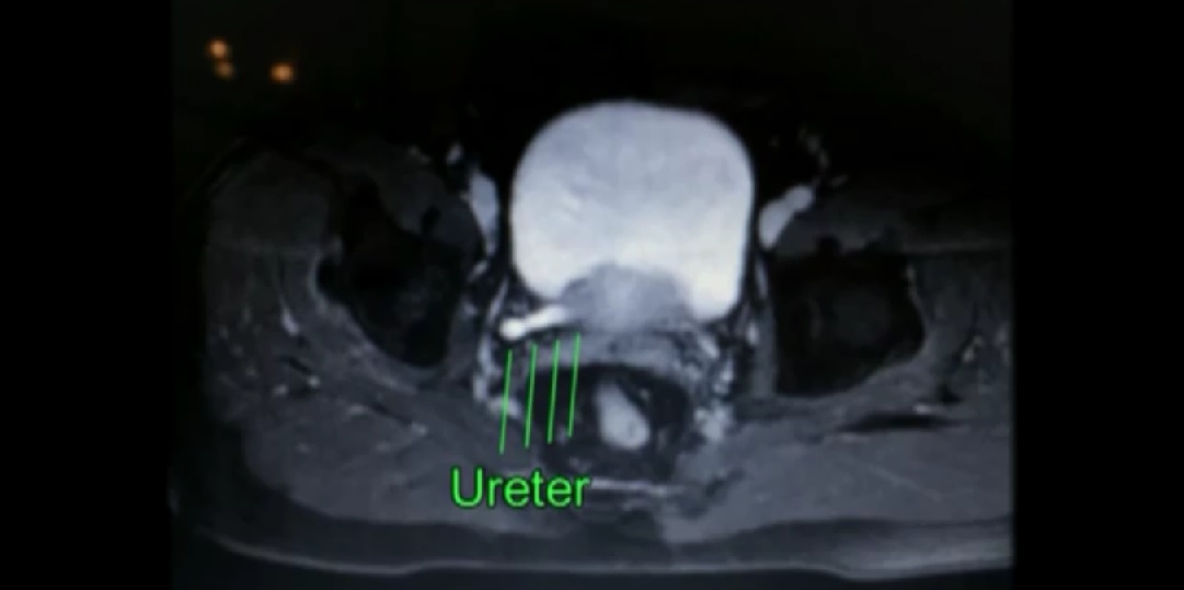 Ureteroscopy with landmarks