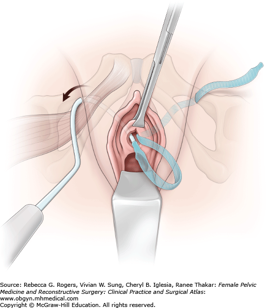 Transobturator Tape Operation(TOT)