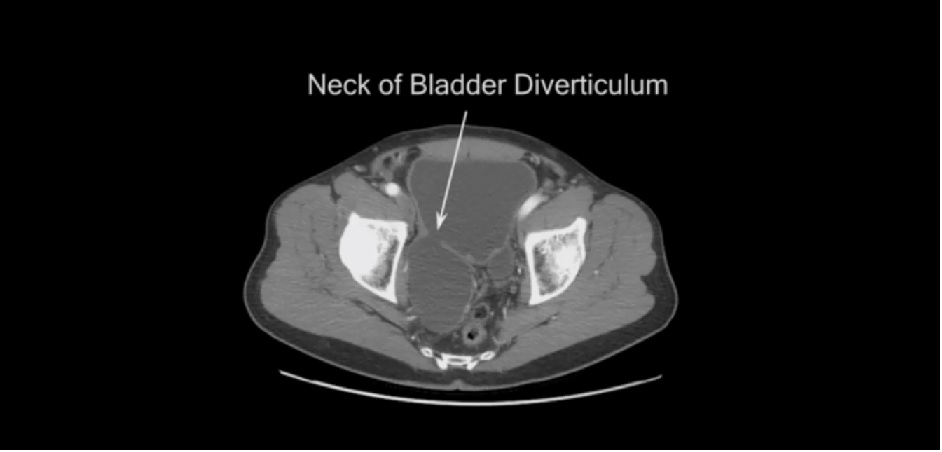  bladder diverticulectomy