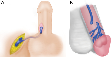 Proximal penile shunt/Barry Shunt-2