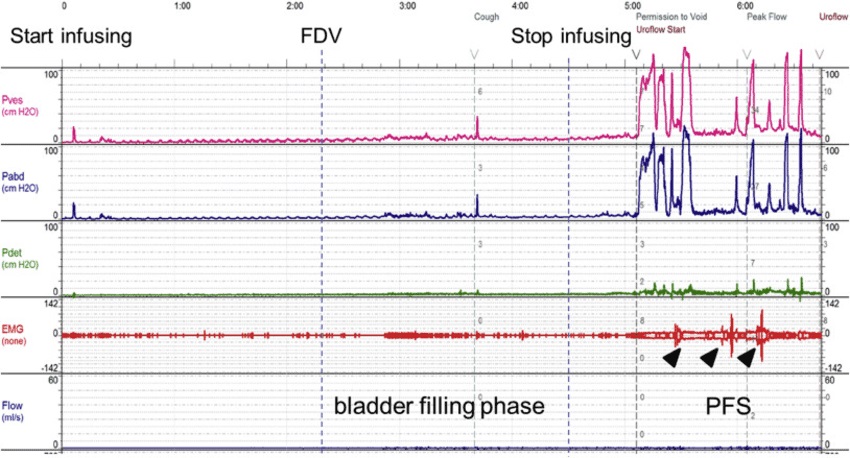 urodynamic interpretation