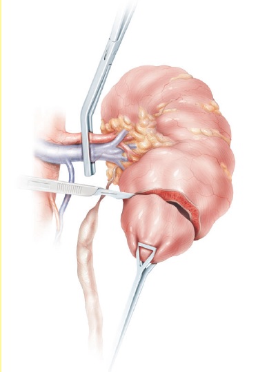  Surgical Atlas of the Open ureterocalycostomy