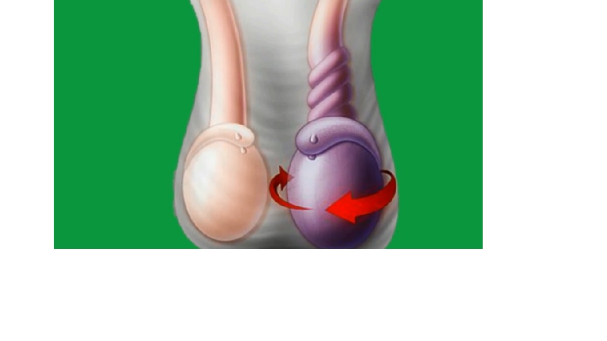  testicular torsion