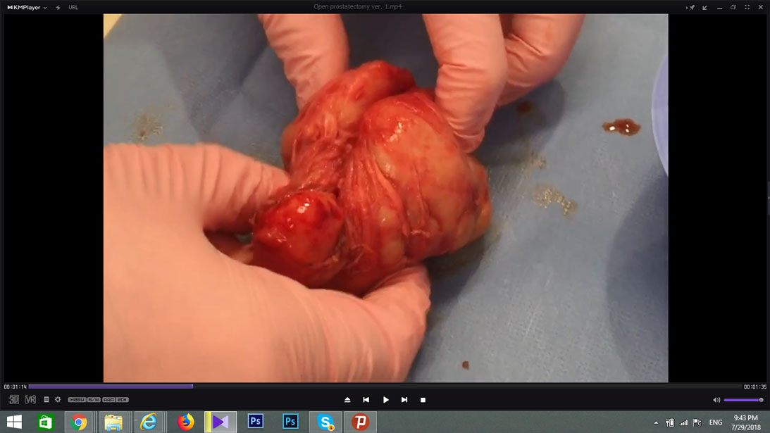 Enucleation of prostate Adenoma