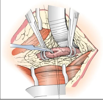 Open ureterolithotomy-anim