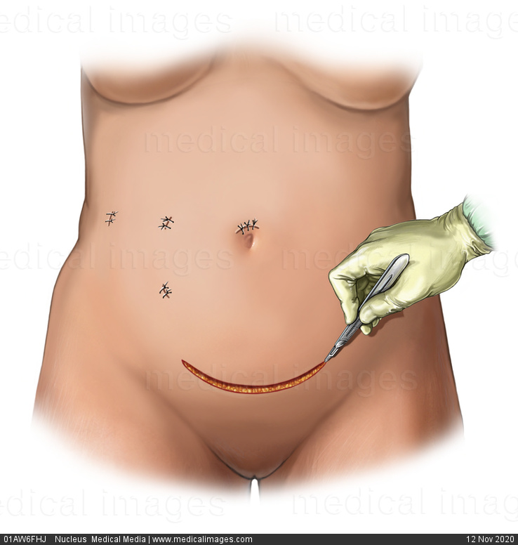 pfannenstiel incision