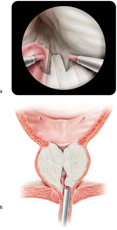 ATLAS OF TURP SURGERY