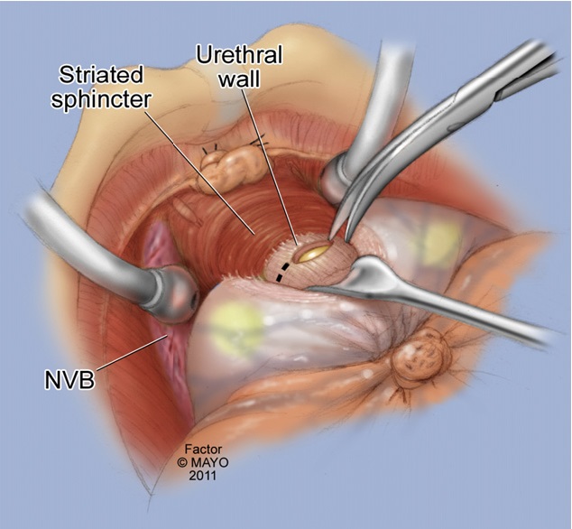 Retropubic simple open prostatectomy