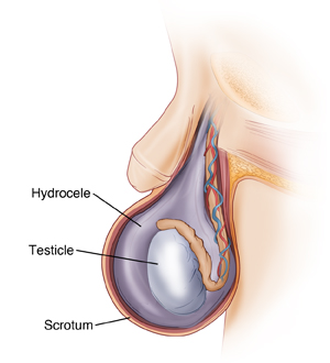 hydrocelectomy