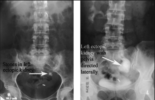 ٍectopic kidney Dj insertion