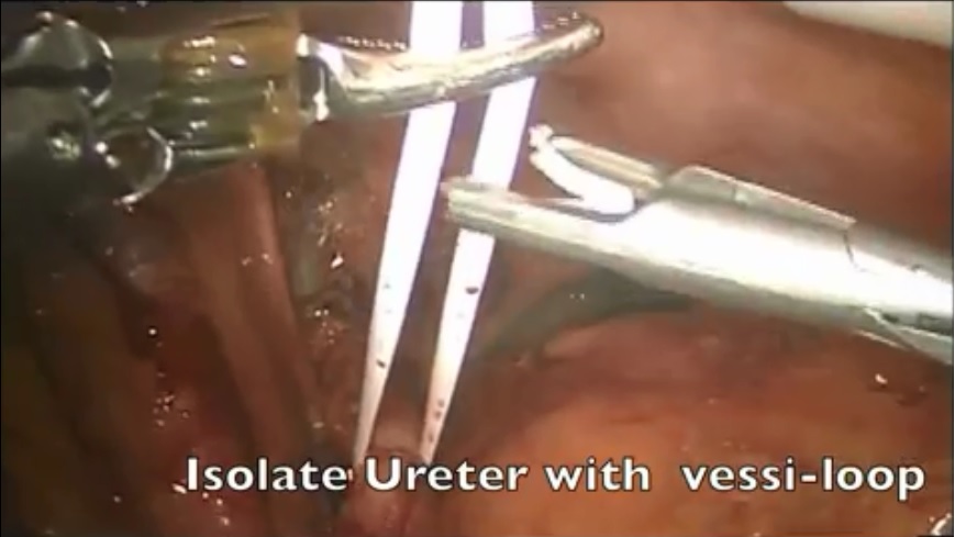 Robotic Ureteral Reimplant Psoas Hitch