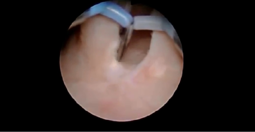 endoscopic incision of uretrocele