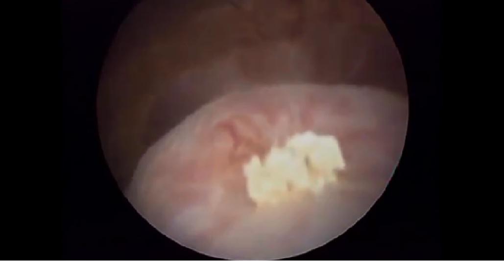 Ureteric Stone Removal by cystoscope and ureteroscope